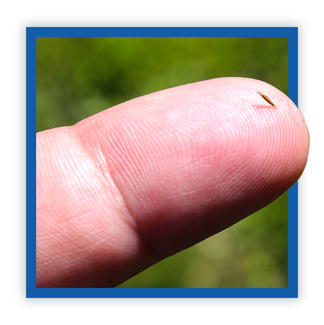 SplinterAid - The World's Best Splinter Extraction Tool